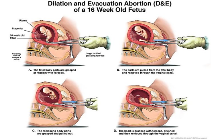 Abortion is murder